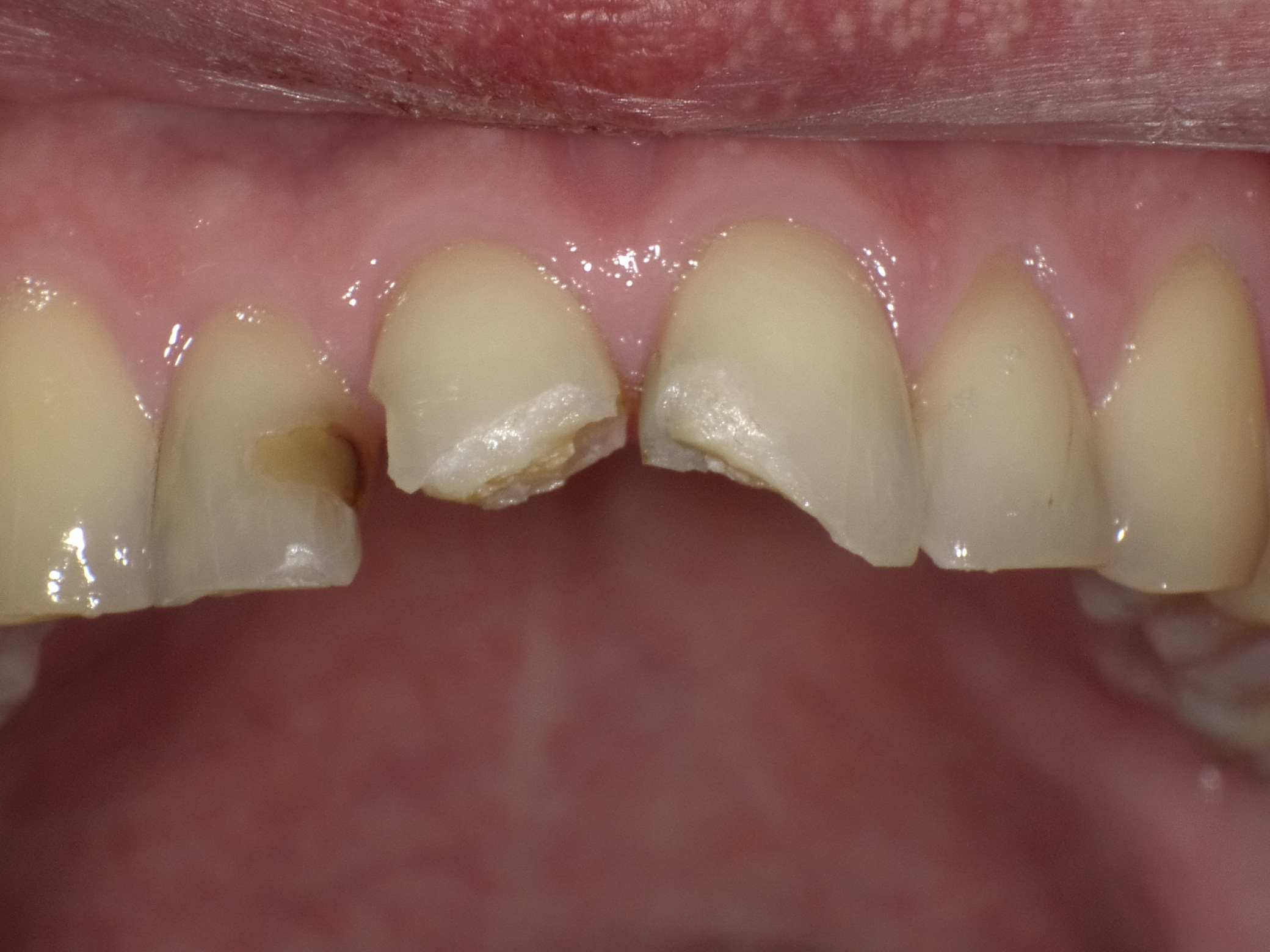 Frontzahnfrakturen nach Unfall